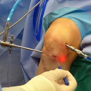 Knee Arthroscopy in Vijayawada