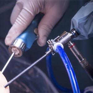 Arthroscopy in Vijayawada
