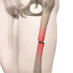 Complex Trauma Treatment
                                                 in Vijayawada