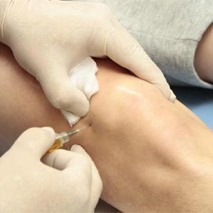 PRP Therapy in Vijayawada