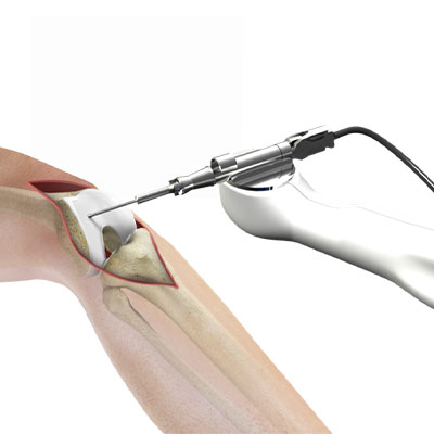 Robotic Joint replacement in Vijayawada