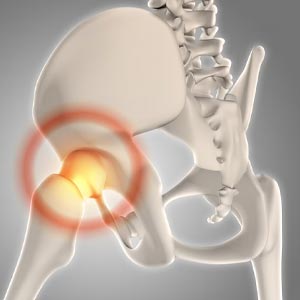 Hip Replacement in Vijayawada