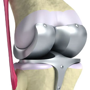 Joint Replacement Surgery in Vijayawada