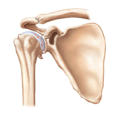 Shoulder Replacement surgery in Vijayawada